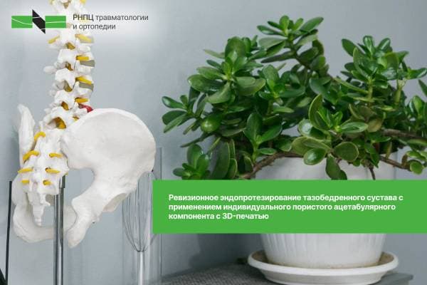 Ревизионное эндопротезирование ТБС с индивидуальным 3D-печатным ацетабулярным компонентом